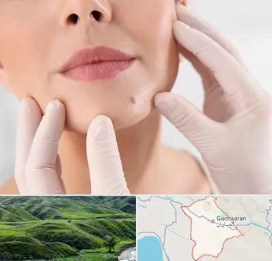 برداشتن خال در گچساران