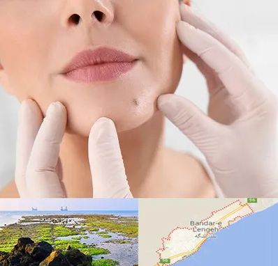 برداشتن خال در بندرلنگه