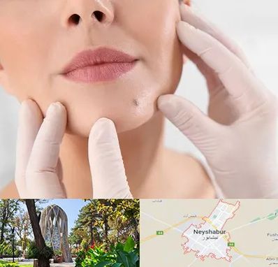 برداشتن خال در نیشابور