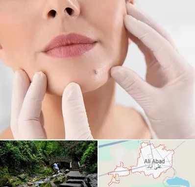 برداشتن خال در علی آباد کتول