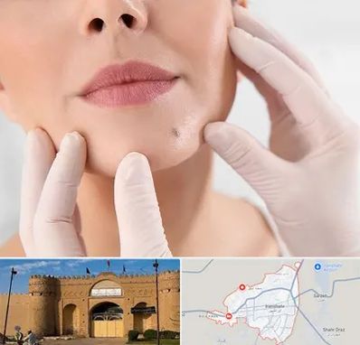 برداشتن خال در ایرانشهر
