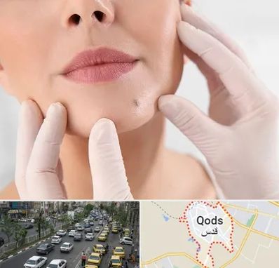 برداشتن خال در شهر قدس