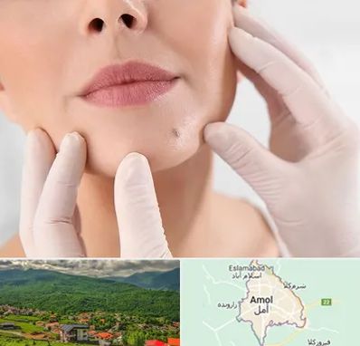 برداشتن خال در آمل