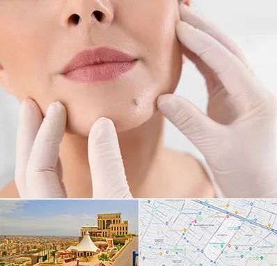 برداشتن خال در هاشمیه مشهد