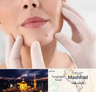 برداشتن خال در مشهد