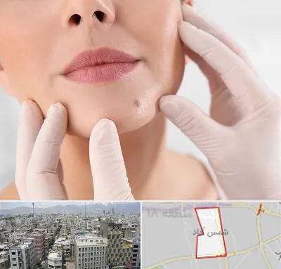 برداشتن خال در شمس آباد تهران