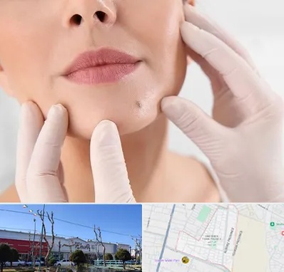 برداشتن خال در فاز دو اندیشه