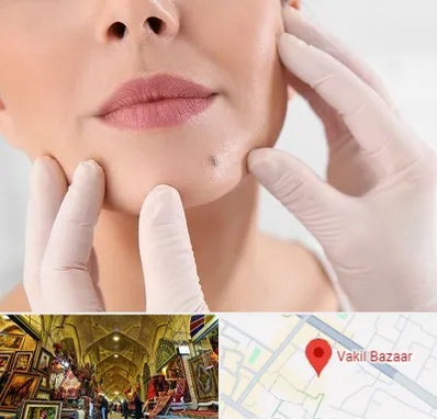 برداشتن خال در بازار وکیل شیراز