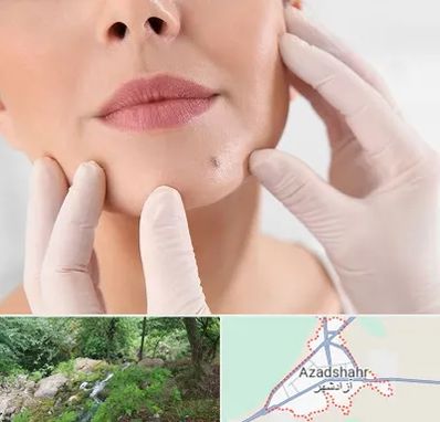 برداشتن خال در آزادشهر