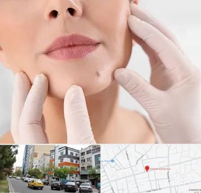 برداشتن خال در هفده شهریور تبریز