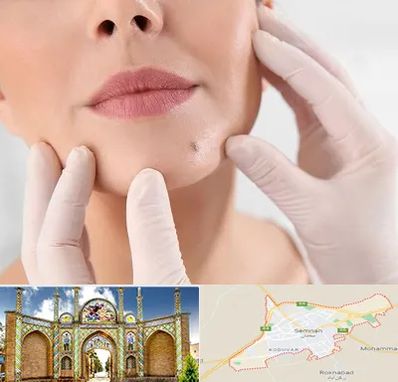 برداشتن خال در سمنان