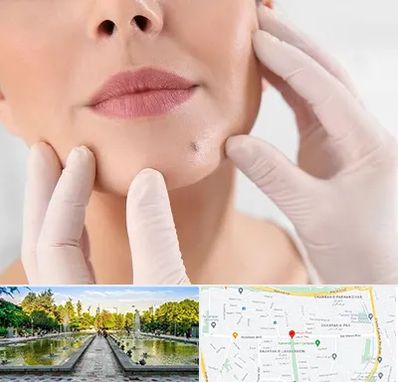 برداشتن خال در سرسبز