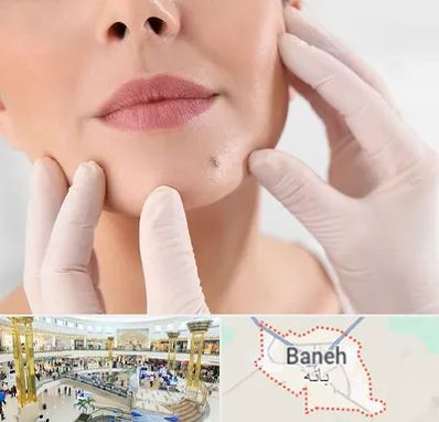 برداشتن خال در بانه