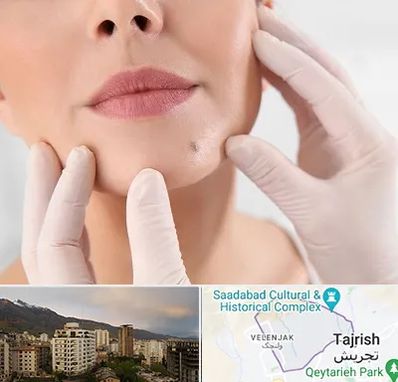 برداشتن خال در زعفرانیه 