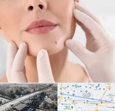 برداشتن خال در فرجام