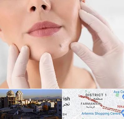 برداشتن خال در فرمانیه 