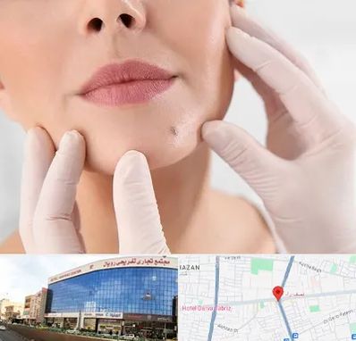 برداشتن خال در نصف راه تبریز