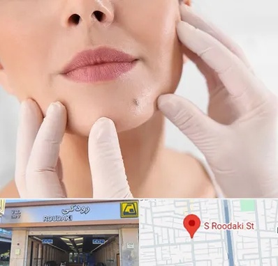 برداشتن خال در رودکی