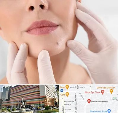 برداشتن خال در سهروردی 