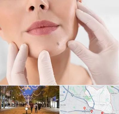 برداشتن خال در ولیعصر ارومیه