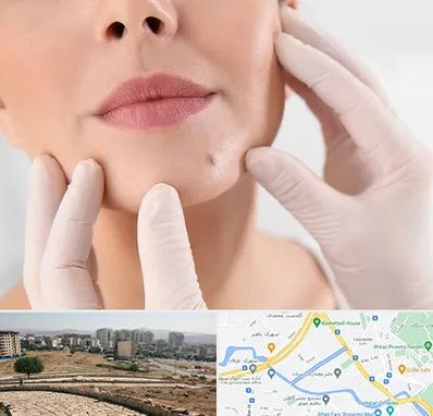 برداشتن خال در کوی وحدت شیراز