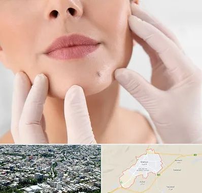 برداشتن خال در شاهرود