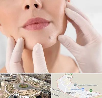 برداشتن خال در پرند