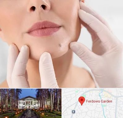 برداشتن خال در باغ فردوس