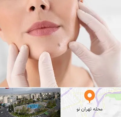 برداشتن خال در تهران نو