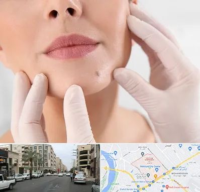 برداشتن خال در زیتون کارمندی اهواز