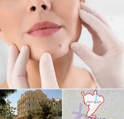 برداشتن خال در مینی سیتی