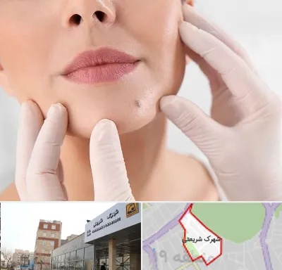 برداشتن خال در شهرک شریعتی