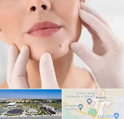 برداشتن خال در ملارد