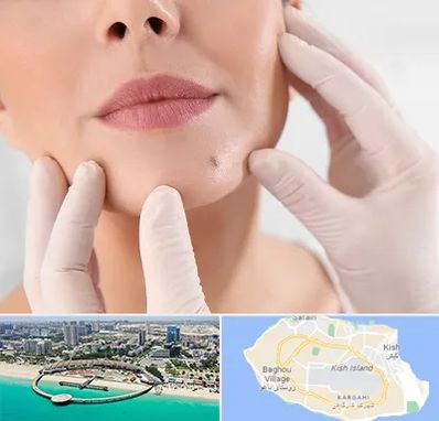 برداشتن خال در کیش