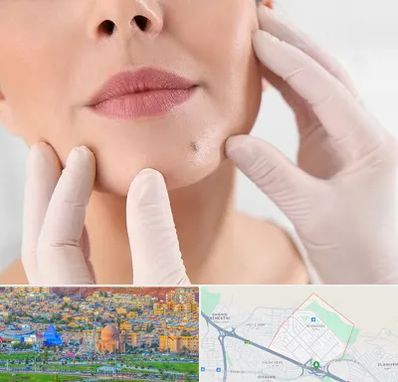 برداشتن خال در رشدیه تبریز