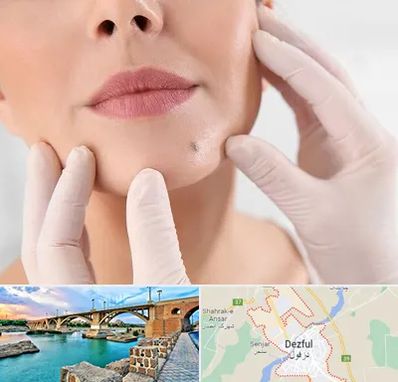 برداشتن خال در دزفول