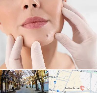 برداشتن خال در تربیت تبریز