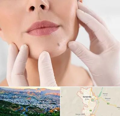 برداشتن خال در سنندج