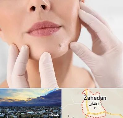 برداشتن خال در زاهدان