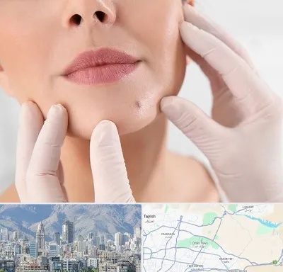 برداشتن خال در شمال شرق تهران
