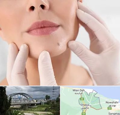 برداشتن خال در چالوس