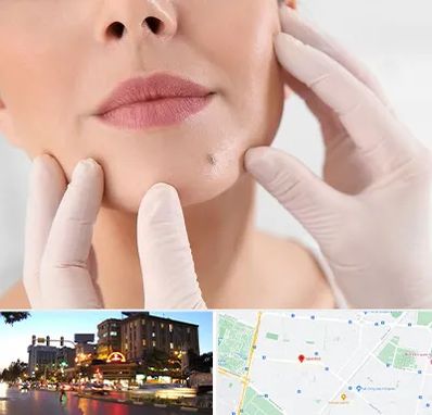 برداشتن خال در بلوار سجاد مشهد