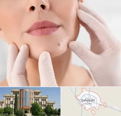 برداشتن خال در دهدشت