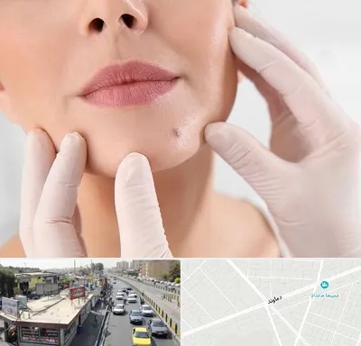 برداشتن خال در خیابان دماوند