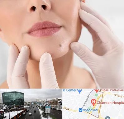 برداشتن خال در اقدسیه 