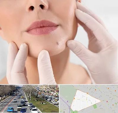 برداشتن خال در احمدآباد مشهد