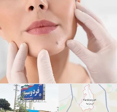 برداشتن خال در فردوسیه شهریار