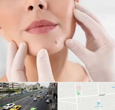 برداشتن خال در خیابان دامپزشکی