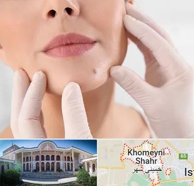 برداشتن خال در خمینی شهر