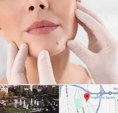 برداشتن خال در آرژانتین